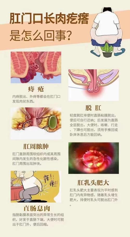 皮硝疗法，痔疮，肉疙瘩，缓解