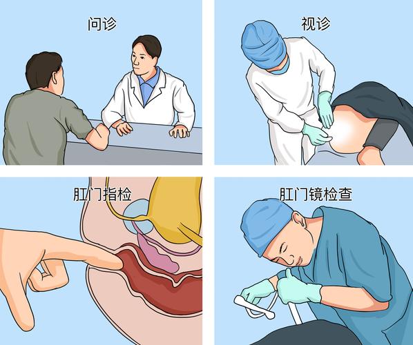  痔疮检查