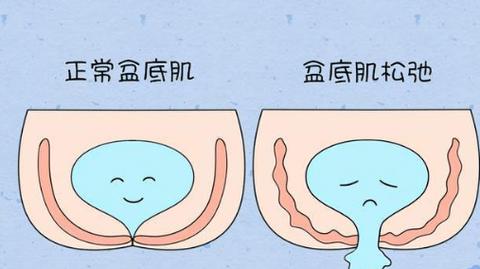 盆底肌肉松弛