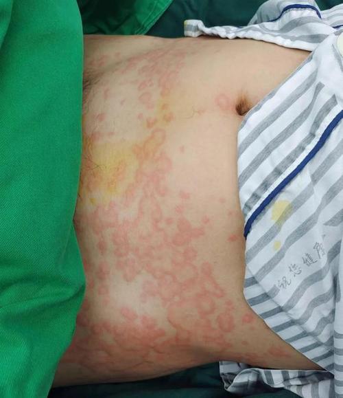 麻醉过敏：痔疮手术后猝死的幕后凶手？