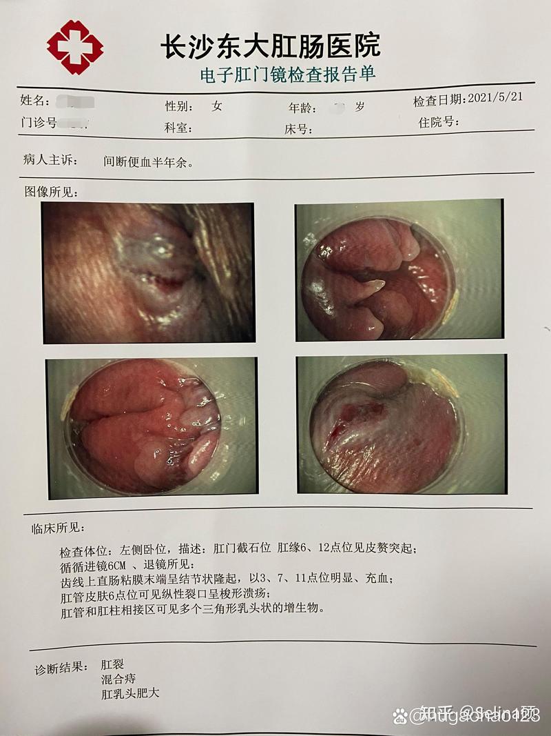 人丹治疗痔疮的效果有多大？